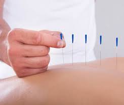 Acupuncture Services in Port Moody: A Gateway to Wellness