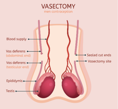Vasectomy Reversal: Restoring Fertility in Kelowna